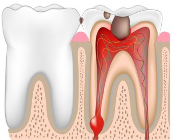 If you have an infected tooth, you should contact a Sacramento ...