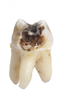 cracked-or-broken-tooth