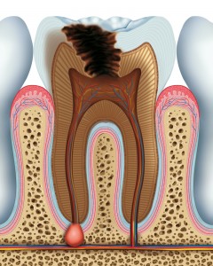 Myths-about-root-canals-roseville-ca