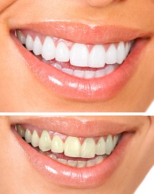 Teeth Whitening Roseville