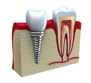 Dental Implants at Sunrise Family Dentistry