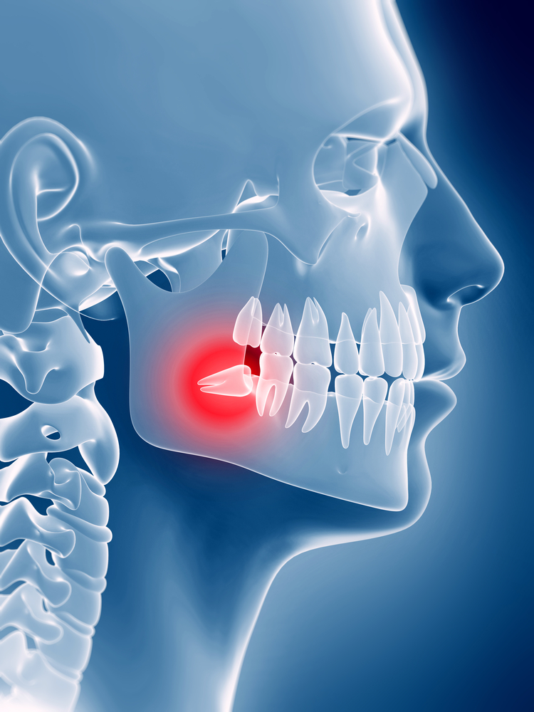How To Relieve Pain From A Wisdom Tooth - Northernpossession24