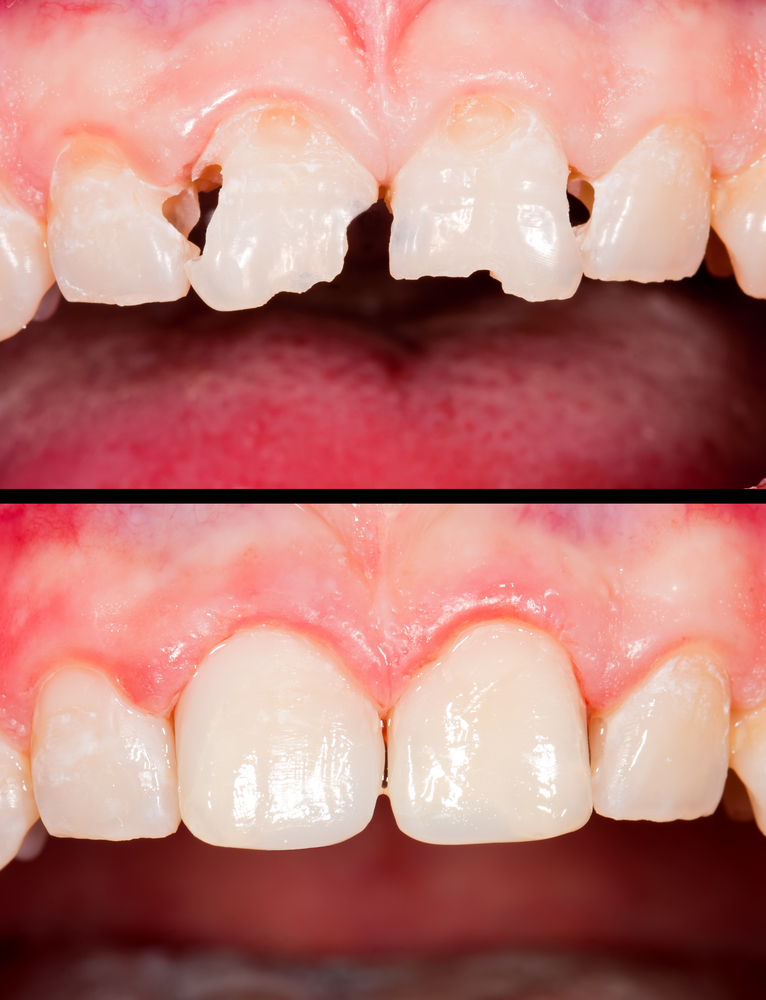 Cavities Winston Salem  Tooth-Colored Fillings Repair Damage