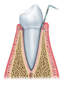 treating-gum-disease-emergency-dentist-sacramento