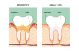 roseville-dentist-Understanding-Periodontal-Disease