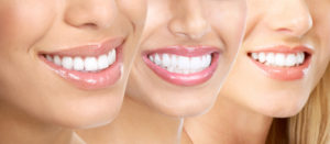 natural-teeth-whitening-roseville-dentist